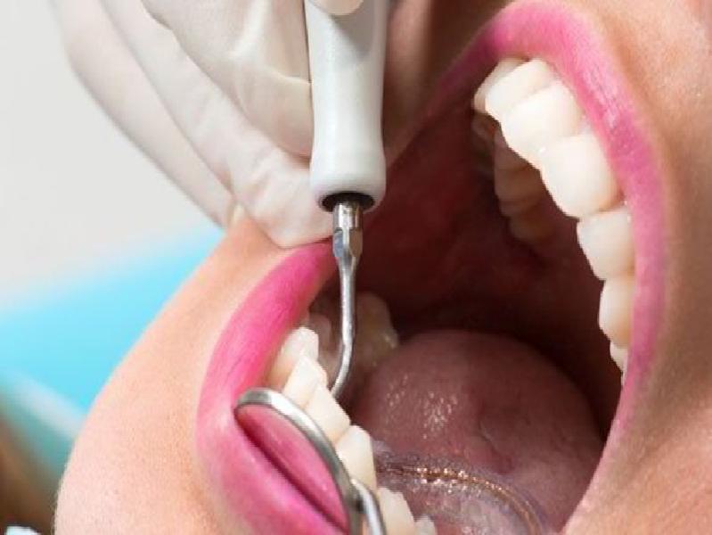چند وقت بعد از عمل بینی میتوان دندانپزشکی رفت - تصویر 1