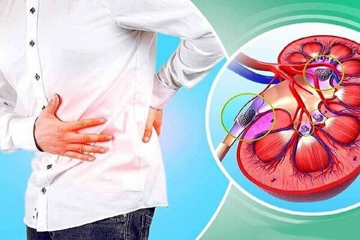 اولین نشانه‌های ابتلا به سنگ کلیه چیست؟