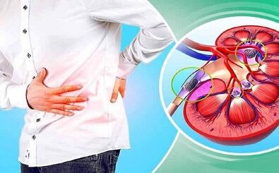 اولین نشانه‌های ابتلا به سنگ کلیه چیست؟