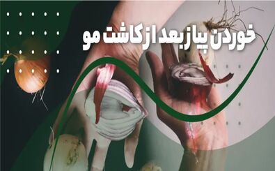 خوردن پیاز بعد از کاشت مو

