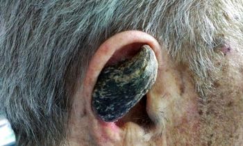 چرا برخی انسان‌ها شاخ درمی‌آورند؟