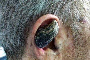 چرا برخی انسان‌ها شاخ درمی‌آورند؟