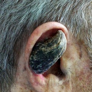 چرا برخی انسان‌ها شاخ درمی‌آورند؟