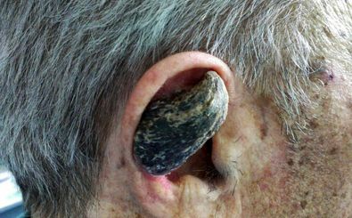 چرا برخی انسان‌ها شاخ درمی‌آورند؟