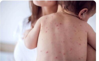 زنگ خطر شیوع مجدد سرخک به صدا درآمد