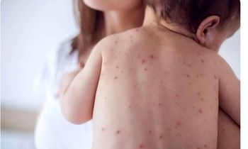 زنگ خطر شیوع مجدد سرخک به صدا درآمد