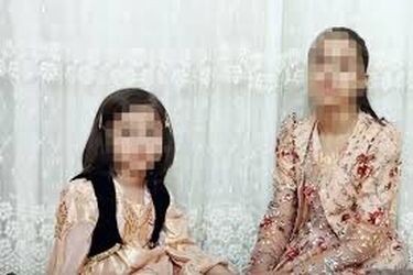 وضعیت دختر سنندجی پس از سه هفته درمان/ عکس قبل و بعد